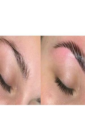 Eyebrow lifting- 9582